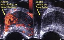 Elaboration d'un nouveau traitement du cancer de la prostate : Les grandes avancées de la recherche Elaboration d'un nouveau traitement du cancer de la prostate : Les grandes avancées de la recherche