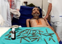 Insolite : Opéré après avoir avalé 40 couteaux Insolite : Opéré après avoir avalé 40 couteaux