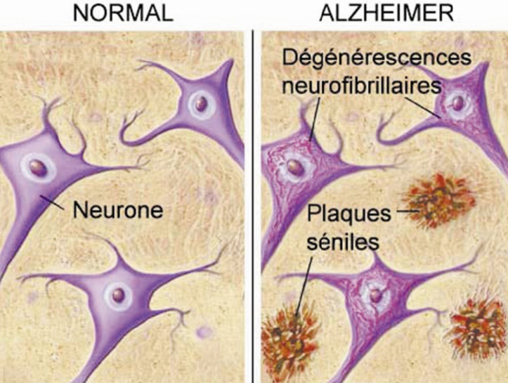 Près de 150.000 Marocains souffrent de la maladie d’Alzheimer