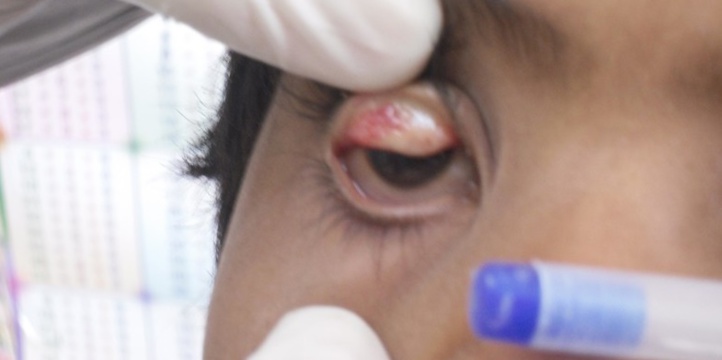 Le Maroc élimine le trachome, principale cause infectieuse de cécité dans le monde Le Maroc élimine le trachome, principale cause infectieuse de cécité dans le monde