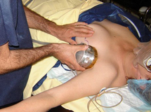 Bévacizumab : La thérapeutique confirmée contre le cancer du sein Bévacizumab : La thérapeutique confirmée contre le cancer du sein