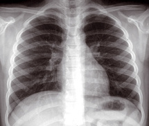 Plus de 25.000 cas déclarés en 2008 : L’éradication de la tuberculose n’est pas pour demain