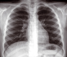 Plus de 25.000 cas déclarés en 2008 : L’éradication de la tuberculose n’est pas pour demain Plus de 25.000 cas déclarés en 2008 : L’éradication de la tuberculose n’est pas pour demain