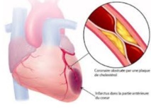 L’infarctus du myocarde en débat à Marrakech L’infarctus du myocarde en débat à Marrakech