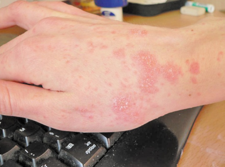 750.000 Marocains souffrent de psoriasis 750.000 Marocains souffrent de psoriasis