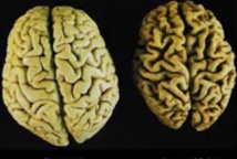 L'inflammation du sang liée à un risque accru d'Alzheimer