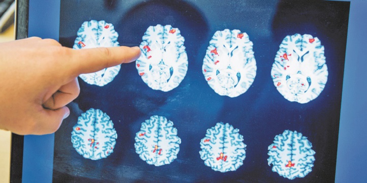 600.000 à 700.000 personnes souffrent d’épilepsie au Maroc 600.000 à 700.000 personnes souffrent d’épilepsie au Maroc