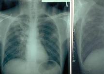 Tuberculose : Journée de sensibilisation à Khouribga Tuberculose : Journée de sensibilisation à Khouribga