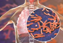 Tuberculose multirésistante: Un nouveau traitement bouleverse la donne