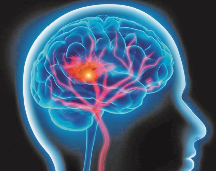 Journée mondiale de l'accident vasculaire cérébral : L’AVC un mal aussi récurrent que méconnu Journée mondiale de l'accident vasculaire cérébral : L’AVC un mal aussi récurrent que méconnu