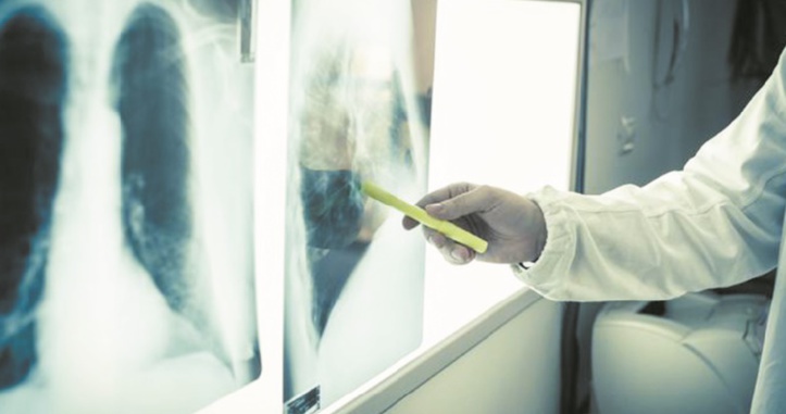 Une femme meurt d’un cancer après avoir reçu les poumons d’une fumeuse Une femme meurt d’un cancer après avoir reçu les poumons d’une fumeuse