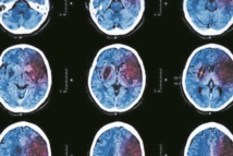 AVC et crise cardiaque pourraient annoncer un cancer 1 mois avant AVC et crise cardiaque pourraient annoncer un cancer 1 mois avant