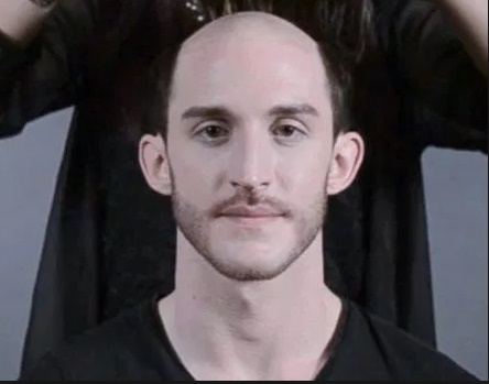 L’impression 3D pour soigner la calvitie L’impression 3D pour soigner la calvitie