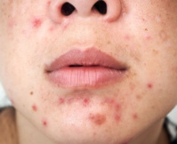 ​Comment traiter l’acné ?
