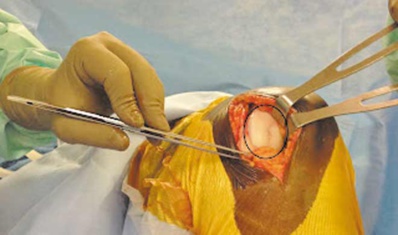 Première mosaïcplastie à Dakhla Première mosaïcplastie à Dakhla