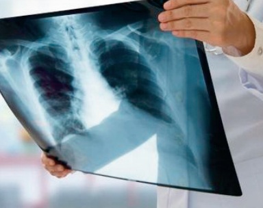 Extension du plan national de prévention et de contrôle de la tuberculose