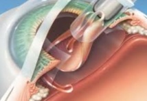 Campagne de chirurgie gratuite de la cataracte Campagne de chirurgie gratuite de la cataracte