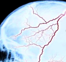 Les lésions cérébrales traumatiques augmentent le risque de décès prématuré Les lésions cérébrales traumatiques augmentent le risque de décès prématuré