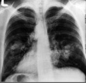 Un dépistage systématique détecterait plus de cancers du poumon Un dépistage systématique détecterait plus de cancers du poumon