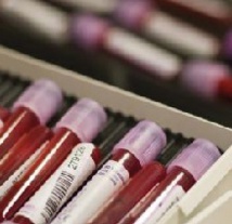 Espoir d’un test sanguin de dépistage précoce d’Alzheimer Espoir d’un test sanguin de dépistage précoce d’Alzheimer