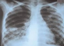 La tuberculose de l’enfant, un problème sous-estimé dans le monde La tuberculose de l’enfant, un problème sous-estimé dans le monde