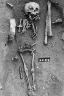 Le plus ancien cas de trisomie 21 identifié sur un squelette trouvé en France Le plus ancien cas de trisomie 21 identifié sur un squelette trouvé en France