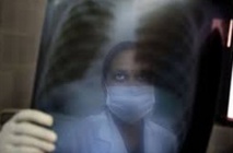 Un nouveau traitement pour soigner les tuberculoses multirésistantes Un nouveau traitement pour soigner les tuberculoses multirésistantes
