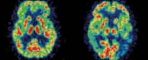 Alzheimer : bientôt un diagnostic simplifié et fiable Alzheimer : bientôt un diagnostic simplifié et fiable