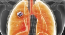 Mise au point d’un test de dépistage précoce du cancer du poumon Mise au point d’un test de dépistage précoce du cancer du poumon