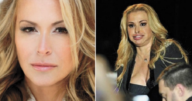 Anastacia, défigurée par le botox ?