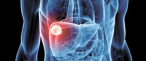 Soufiane Mellas : Le Maroc enregistre chaque année 30.000 cas de cancer Soufiane Mellas : Le Maroc enregistre chaque année 30.000 cas de cancer