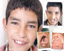 L’Opération Smile Morocco fait escale à Dakhla L’Opération Smile Morocco fait escale à Dakhla