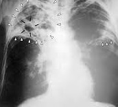 Renforcer le dépistage de la tuberculose parmi les populations à haut risque Renforcer le dépistage de la tuberculose parmi les populations à haut risque