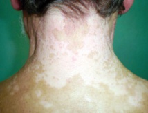 ​Un Tunisien trouve un traitement contre la maladie du vitiligo