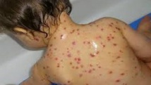 La rougeole affaiblirait le système immunitaire des enfants La rougeole affaiblirait le système immunitaire des enfants