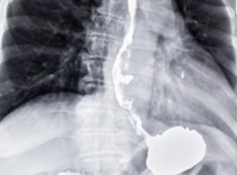 Des anti-acides pour l'estomac augmentent peut-être le risque de crise cardiaque Des anti-acides pour l'estomac augmentent peut-être le risque de crise cardiaque