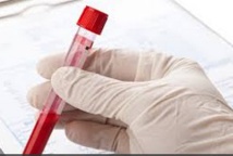 Les cancers du cou et de la gorge bientôt dépistés par la salive et le sang Les cancers du cou et de la gorge bientôt dépistés par la salive et le sang