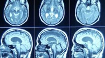 Lien confirmé entre faible niveau de vitamine D et sclérose en plaques