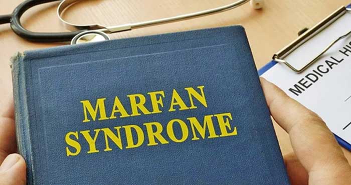 Le Syndrome de Marfan expliqué à Rabat Le Syndrome de Marfan expliqué à Rabat