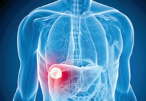 Un nouveau médicament contre l'hépatite C bientôt sur le marché Un nouveau médicament contre l'hépatite C bientôt sur le marché