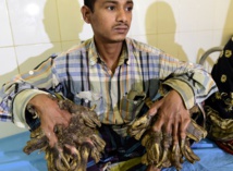 Insolite : “Homme-arbre” Insolite : “Homme-arbre”