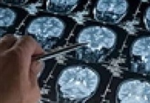 Pas de lien automatique entre commotions et dégénérescence neurologique