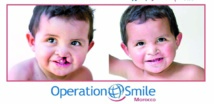 Réparation des malformations faciales au profit des enfants à Ouarzazate Réparation des malformations faciales au profit des enfants à Ouarzazate