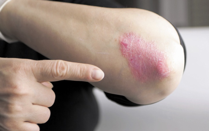 Le psoriasis, une maladie chronique de la peau qui touche 750.000 patients au Maroc Le psoriasis, une maladie chronique de la peau qui touche 750.000 patients au Maroc