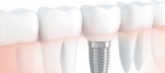 Réponses d’expert : Est-il vrai que les implants dentaires sont déconseillés aux fumeurs ?