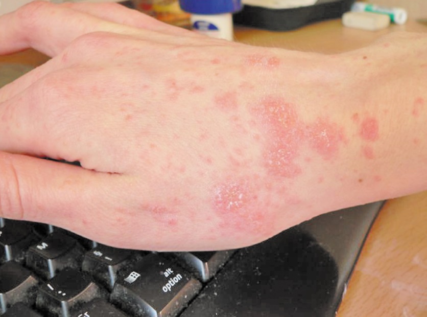750.000 Marocains souffrent de psoriasis