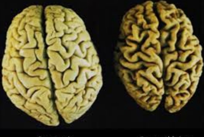 L'inflammation du sang liée à un risque accru d'Alzheimer L'inflammation du sang liée à un risque accru d'Alzheimer