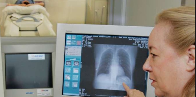 Plus de cancers du poumon chez les jeunes femmes que les jeunes hommes aux USA