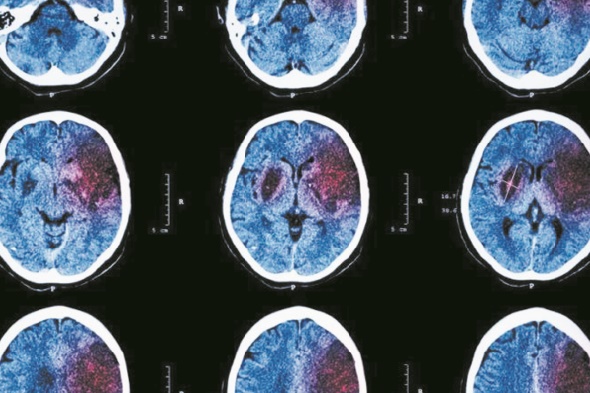 AVC et crise cardiaque pourraient annoncer un cancer 1 mois avant