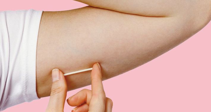 Un implant contraceptif pour limiter les naissances